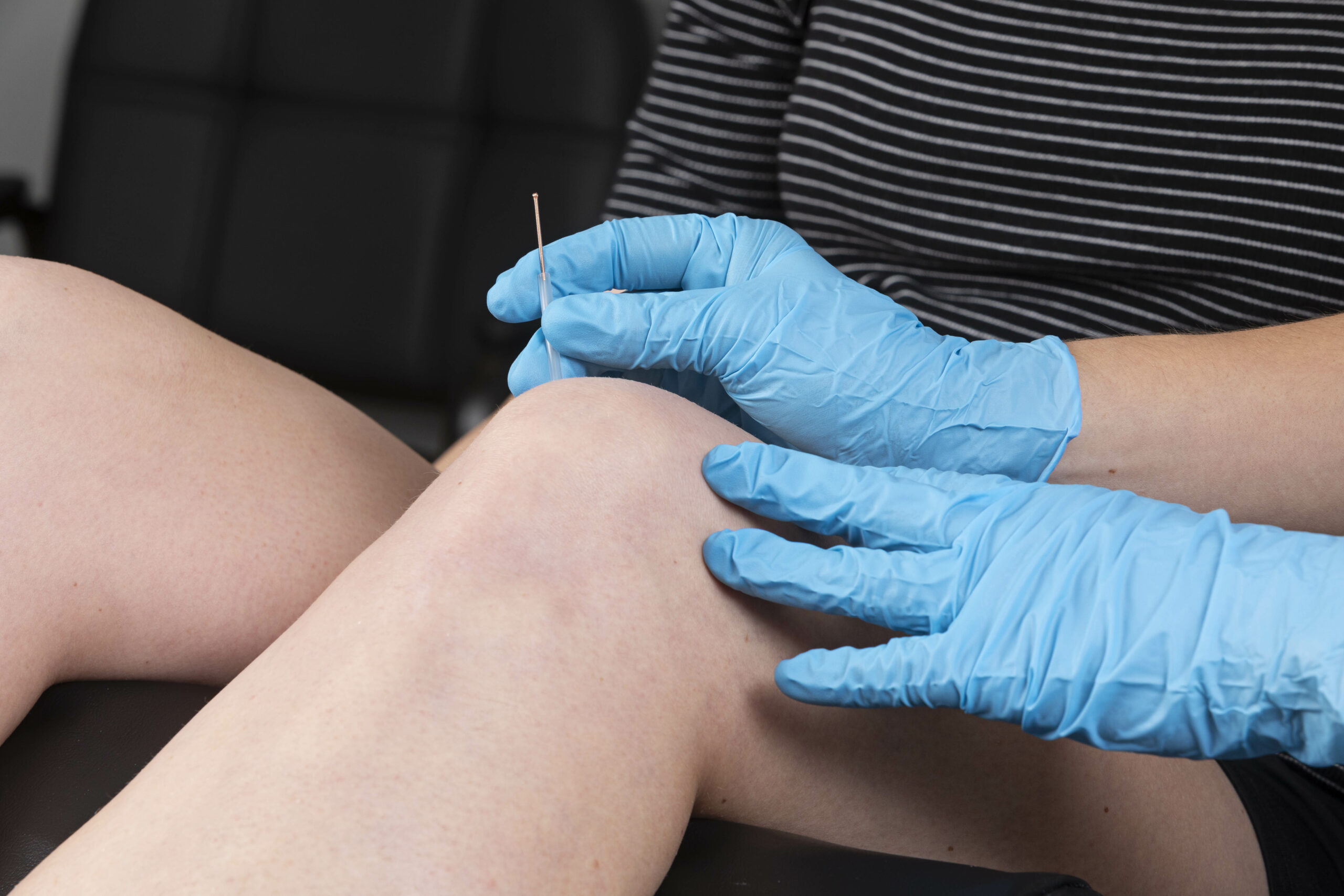 Shows an acupuncture needle being inserted into a knee