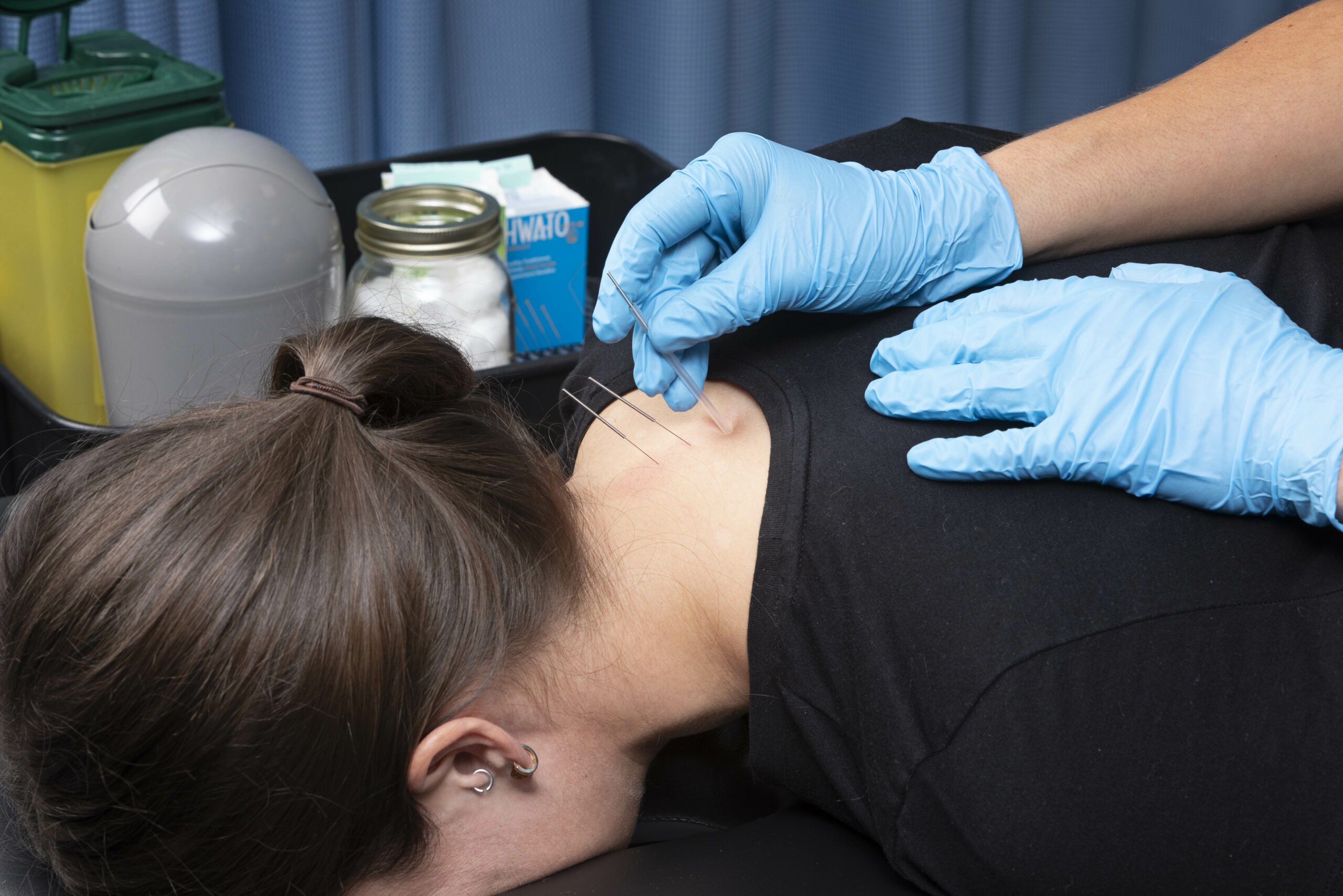 Shows the back of a neck with a few acupuncture needles inside it.